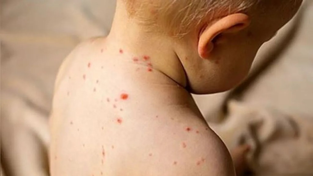 Alerta sanitaria en Entre Ríos por caso confirmado de&nbsp;sarampión
